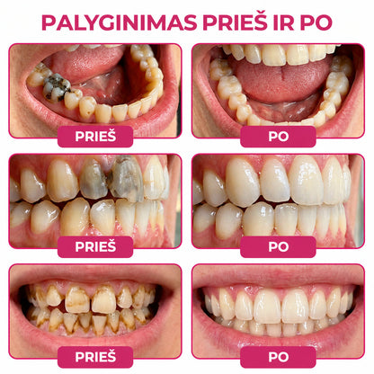 🍟🍟Keyess® DenPerm ėduonies pažeidimus atkuriantis natūralaus emalio užpildymo gelis