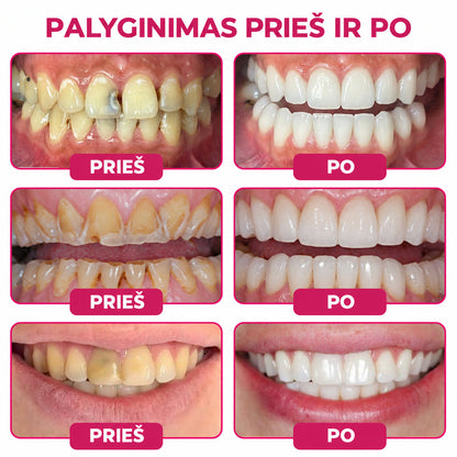 🍟🍟Keyess® DenPerm ėduonies pažeidimus atkuriantis natūralaus emalio užpildymo gelis
